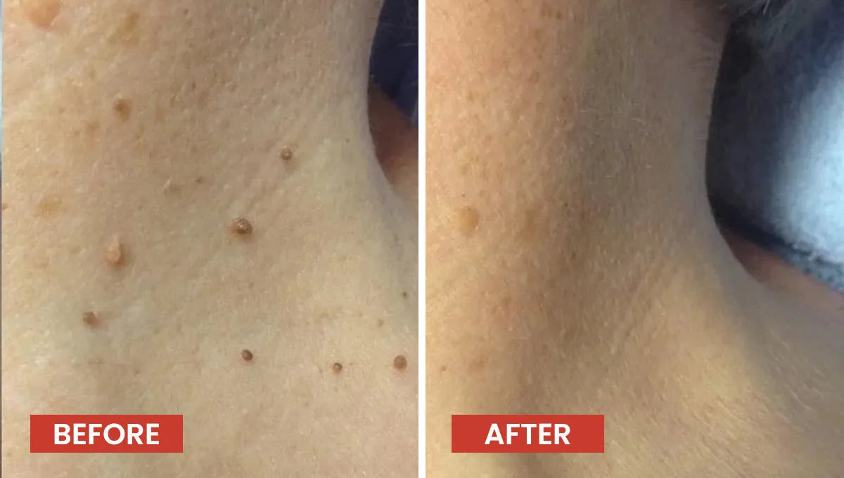 Derma Smooth Skin Tag Removal Patches